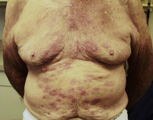 Researchers Find Cause and Cure Path for Lupus