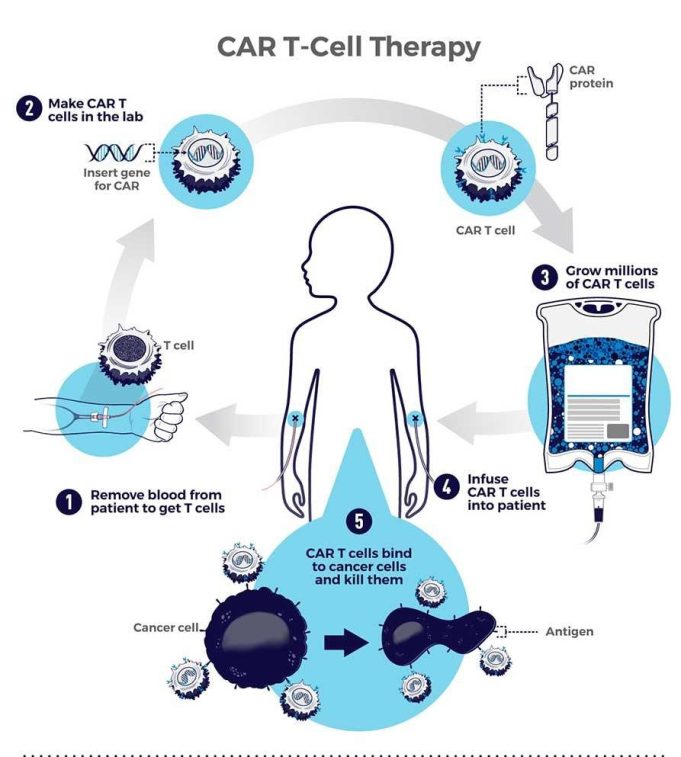 Car T Cell Infusion Therapy Car T Cell Infusion Therapy
